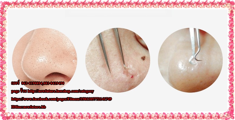 HE-095ที่กดสิว แหนบดึงสิวเสี้ยน แหนบกดสิว อุปกรณ์กดและดึงสิวเสี้ยน
